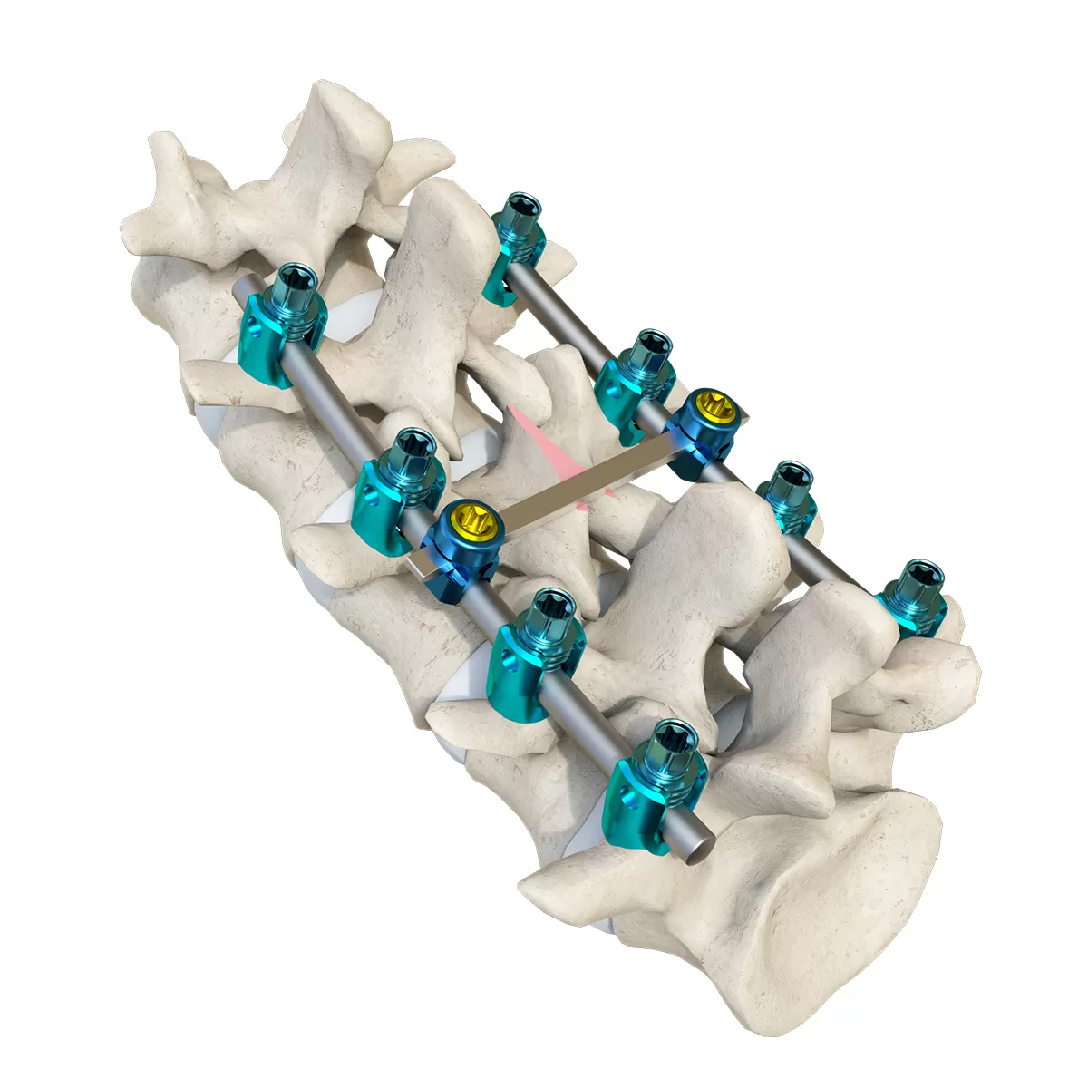 How Do Spinal Fusion Implants Improve Postoperative Stability?