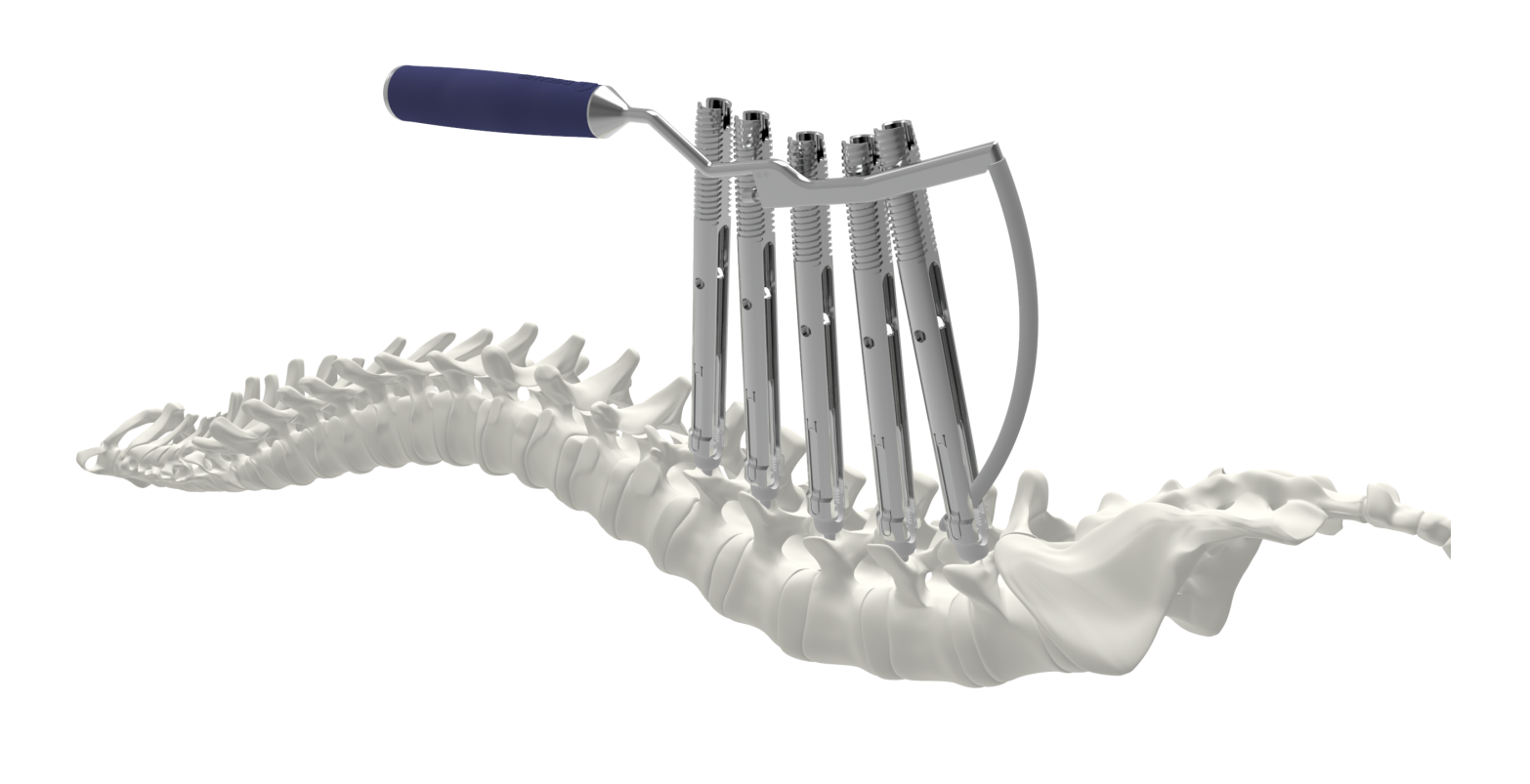 Percutaneous Pedicle Screw Fixation Minimally Invasive