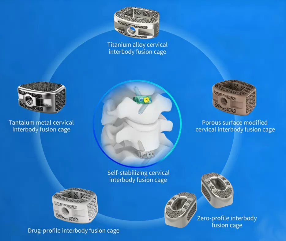 3D Printed Spinal Interbody Fusion Cage: The Future of Lumbar Fusion Implants