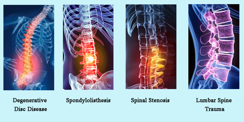 Clinical Applications of Lumbar Titanium Cage Implants.png