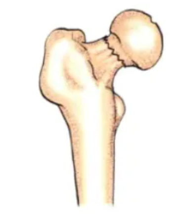 Incomplete or valgus impacted fracture