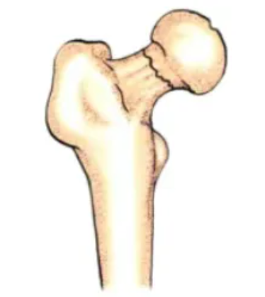 Complete fracture without displacement