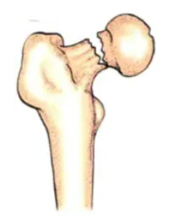 Partial displacement