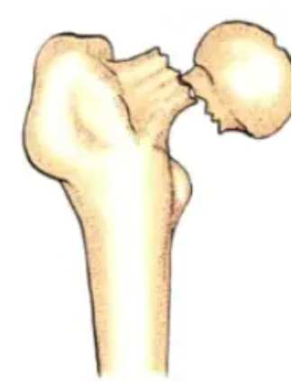 Complete displacement