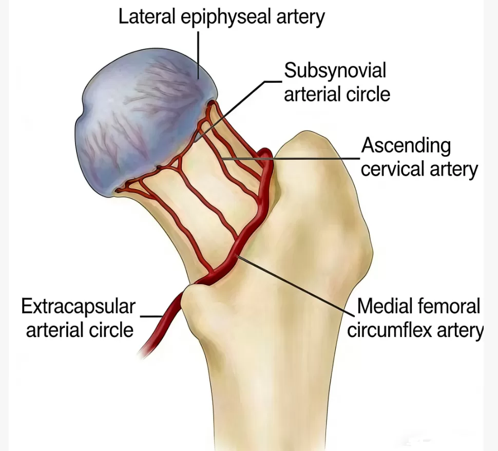 Femoral Neck Fracture Fixation Solution