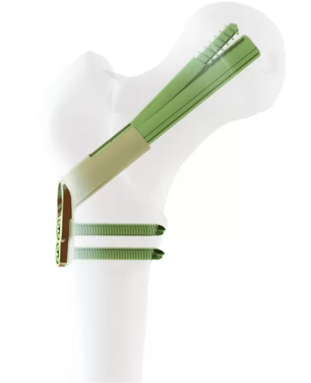 Femoral Neck System (FNS)