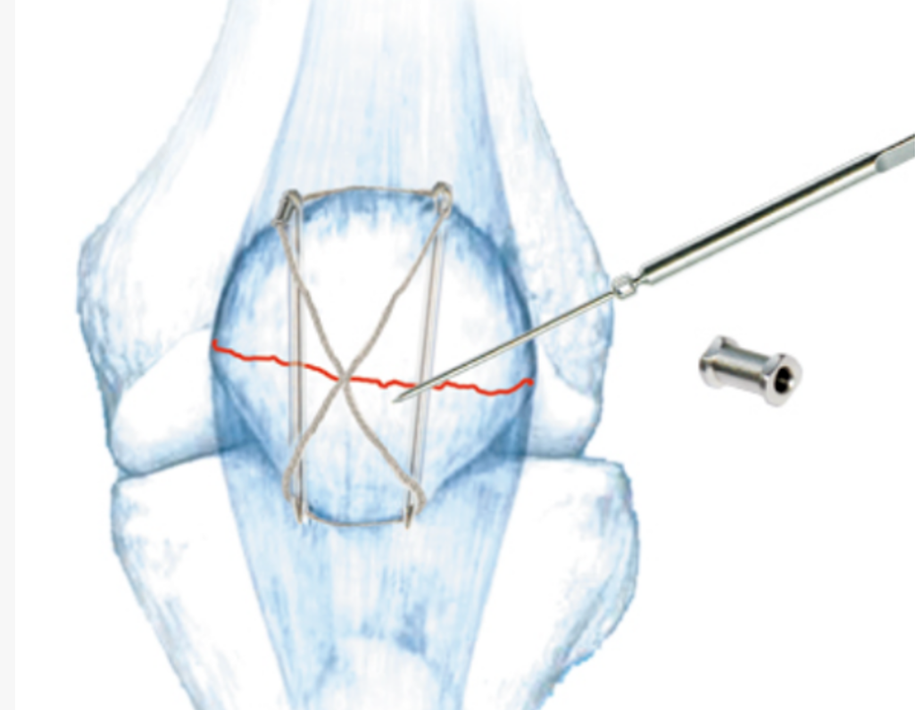 Patellar tension band fixation