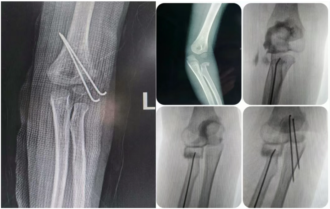 percutaneous insertion
