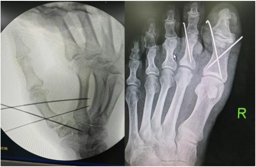 Metacarpal fractures are the main cause of fractures.