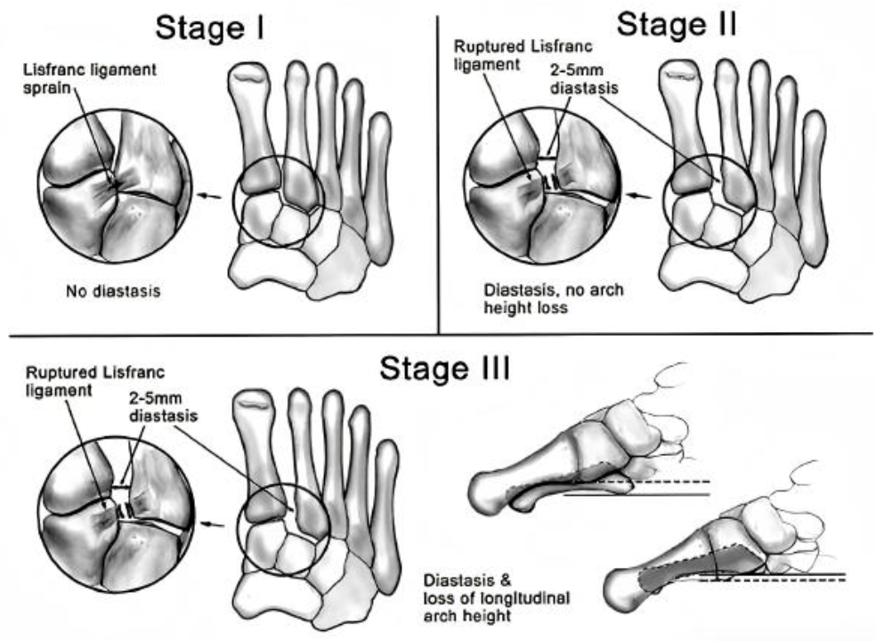 Lisfranc Ligament Injury Classification