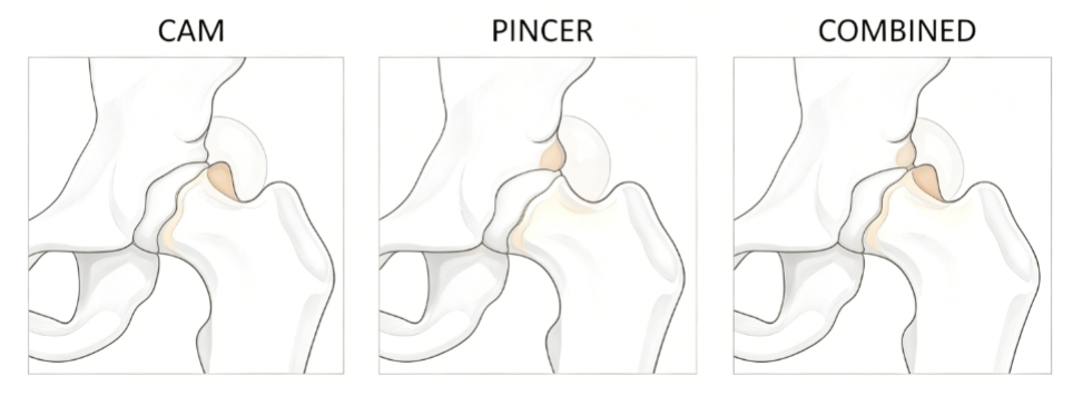 Understanding Femoroacetabular Impingement