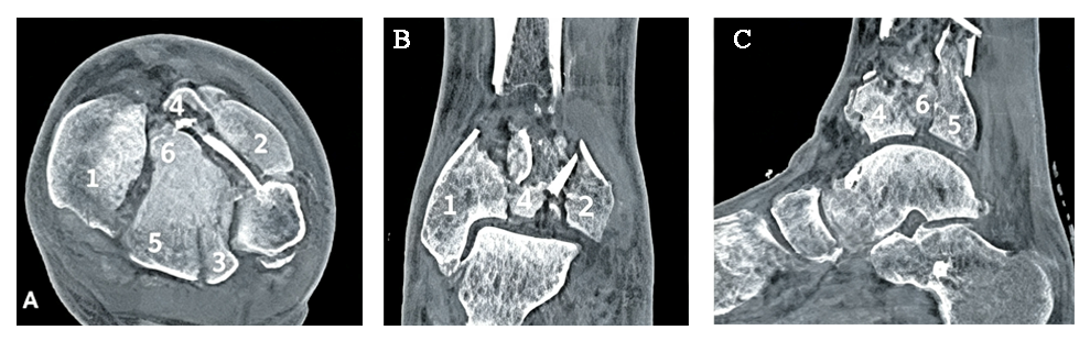 CT imaging of a comminuted tibial plafond Pilon fracture