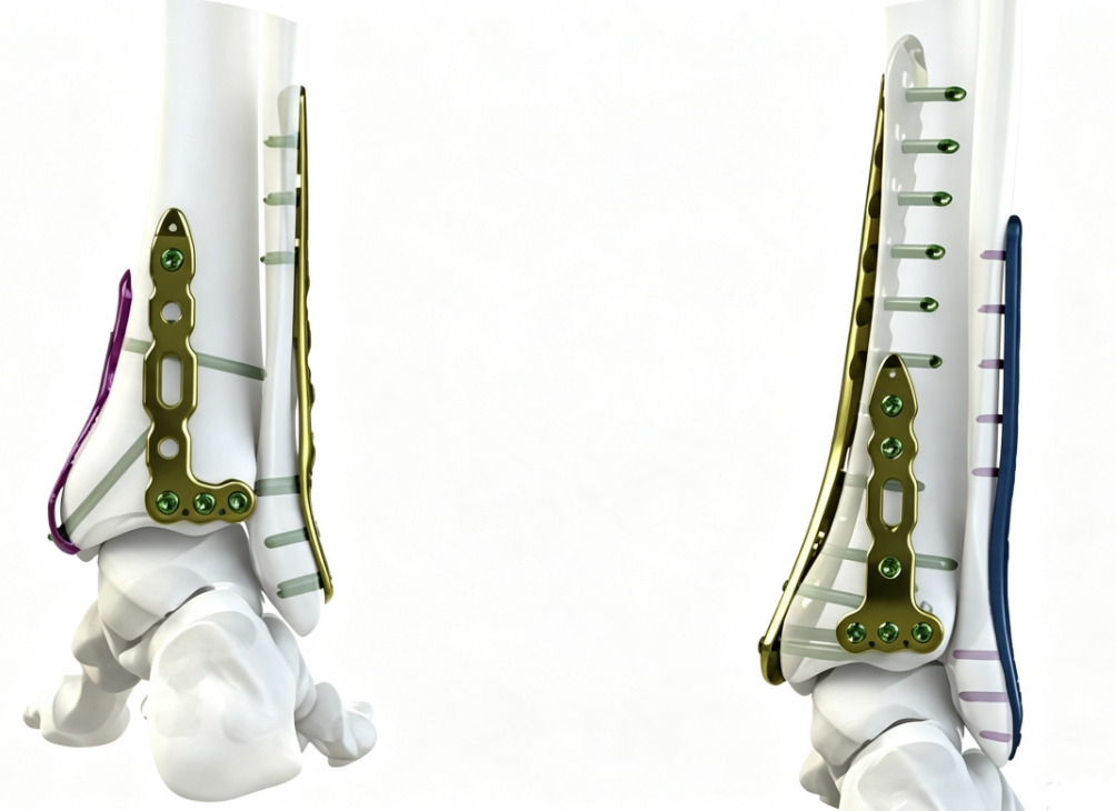 ATOM distal tibia locking plates for Pilon fracture fixation