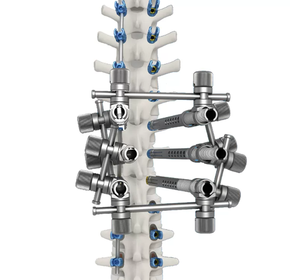 Ti Posterior Rod-Screw for Spinal Deformity (5.5 System)