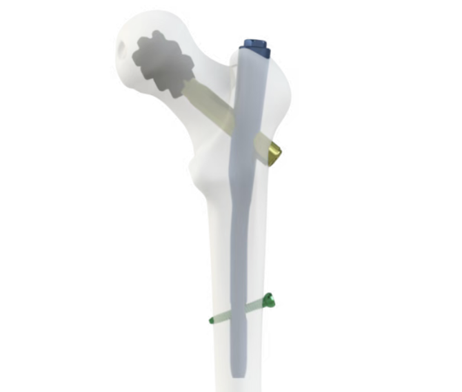 Bone cement-augmented PFNA