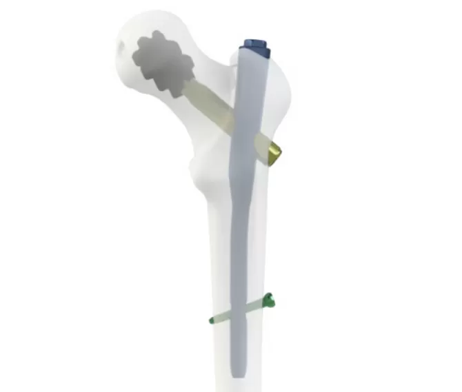 Cement-Augmented PFNA for Osteoporotic Intertrochanteric Fractures in Older Adults