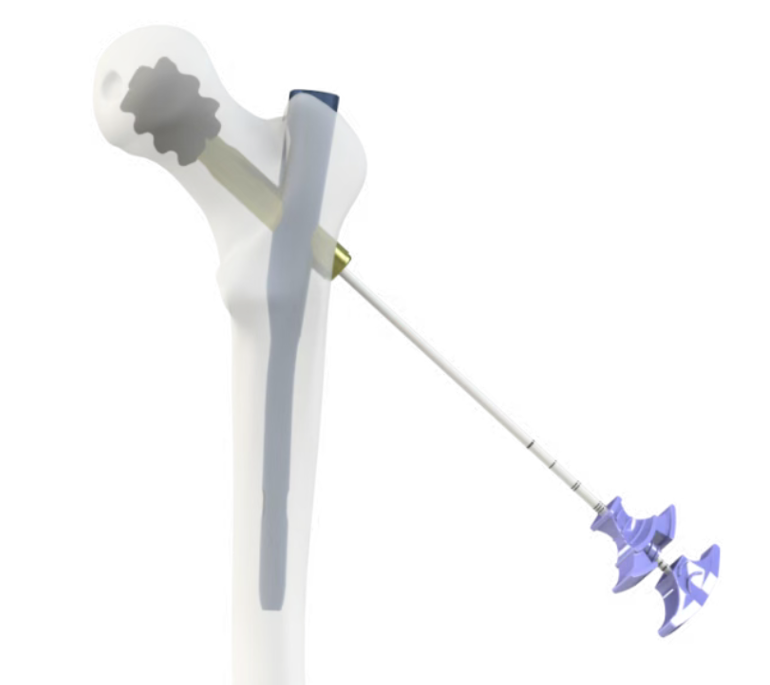 Bone cement augmentation technique