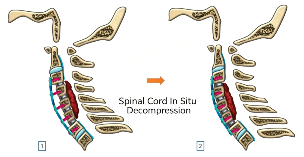 Spinal Cord In Situ Decompression