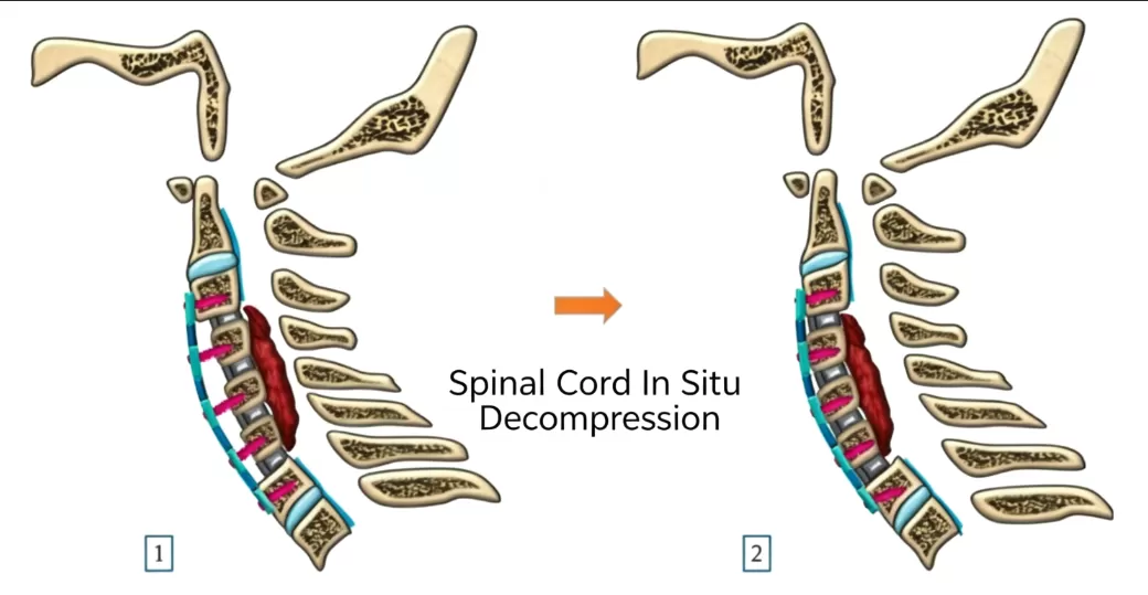 Anterior Cervical Plate Fixation in Cervical Fusion