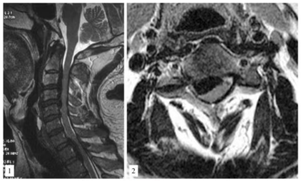 cervical OPLL