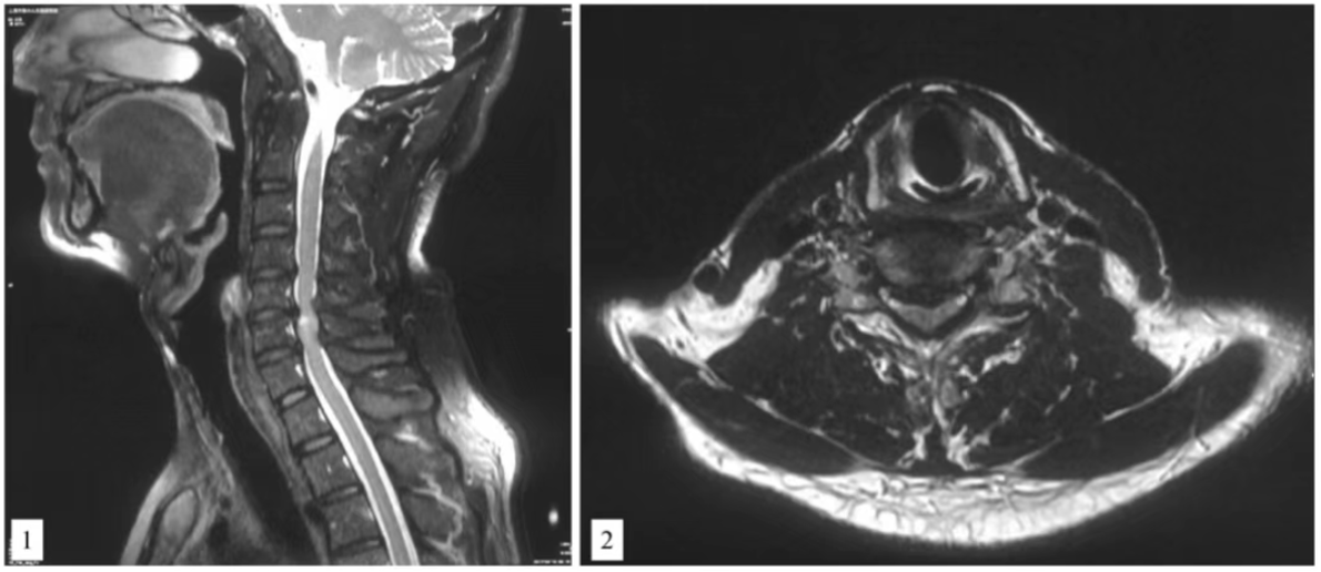 MRI images of cervical spondylotic myelopathy
