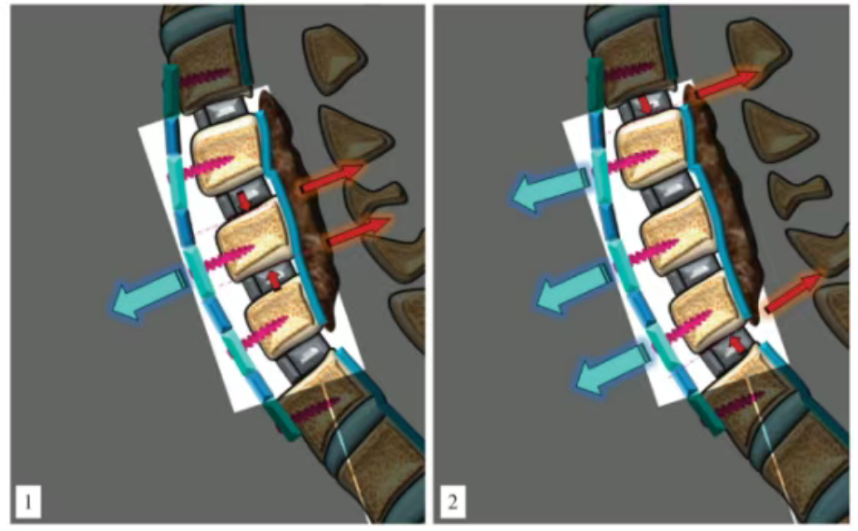 Anterior cervical plate positioning and screw trajectory in cervical fusion