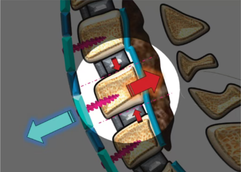 Traction force and resistance in vertebral body anterior displacement
