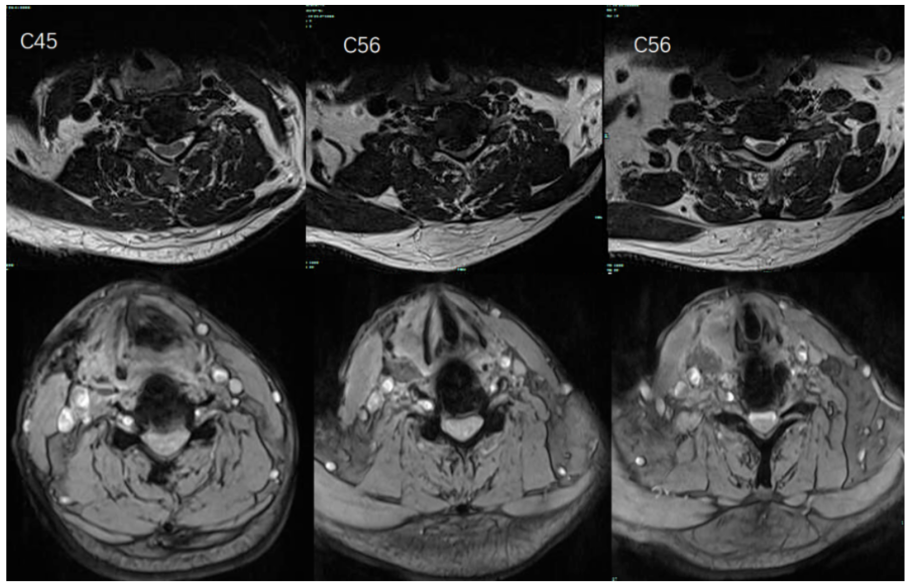 Postoperative MRI images